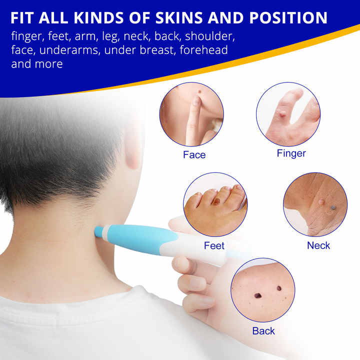 2 In1 Painless Auto Skin Tag Mole Removal Kit
